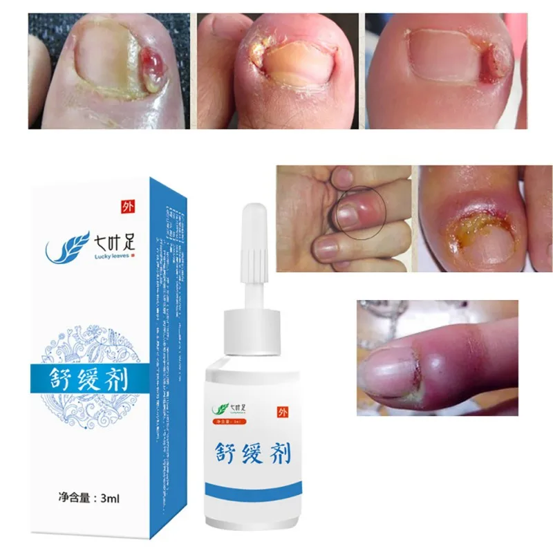 

1PC Fungal Nail Treatment Feet Care Essence Nail and Foot Whitening Toe Nail Fungus Removal Nail Gel ryh