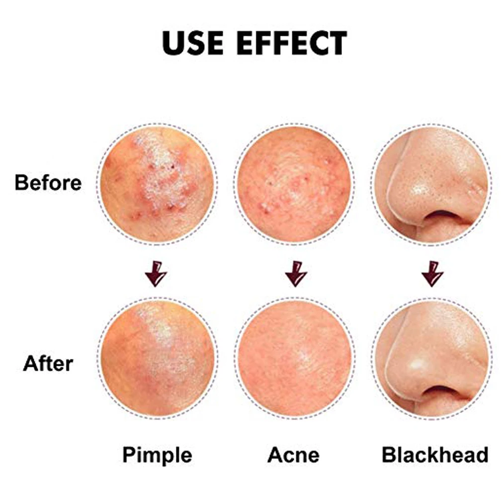 5 шт Blackhead прыщ, шрам, акне игла для чистки лица экстрактор для удаления набор инструментов