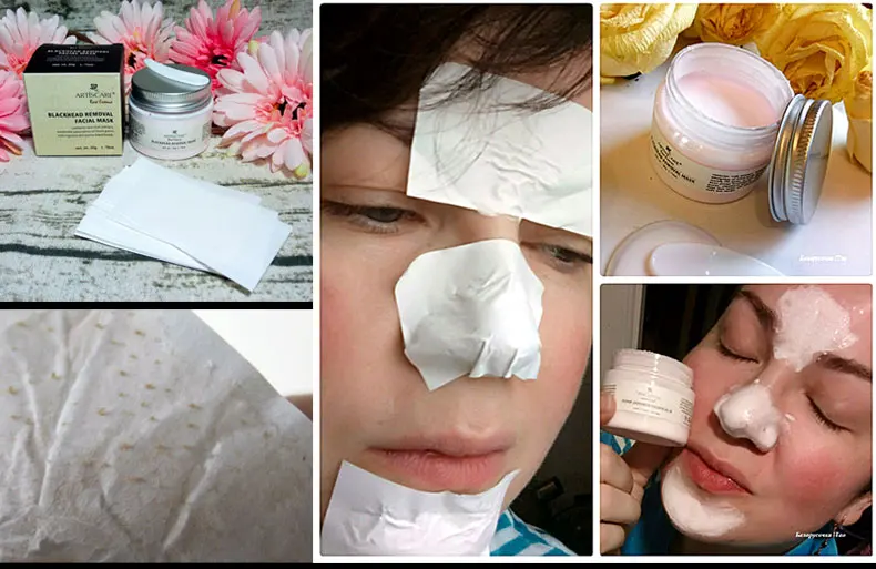 blackhead_01