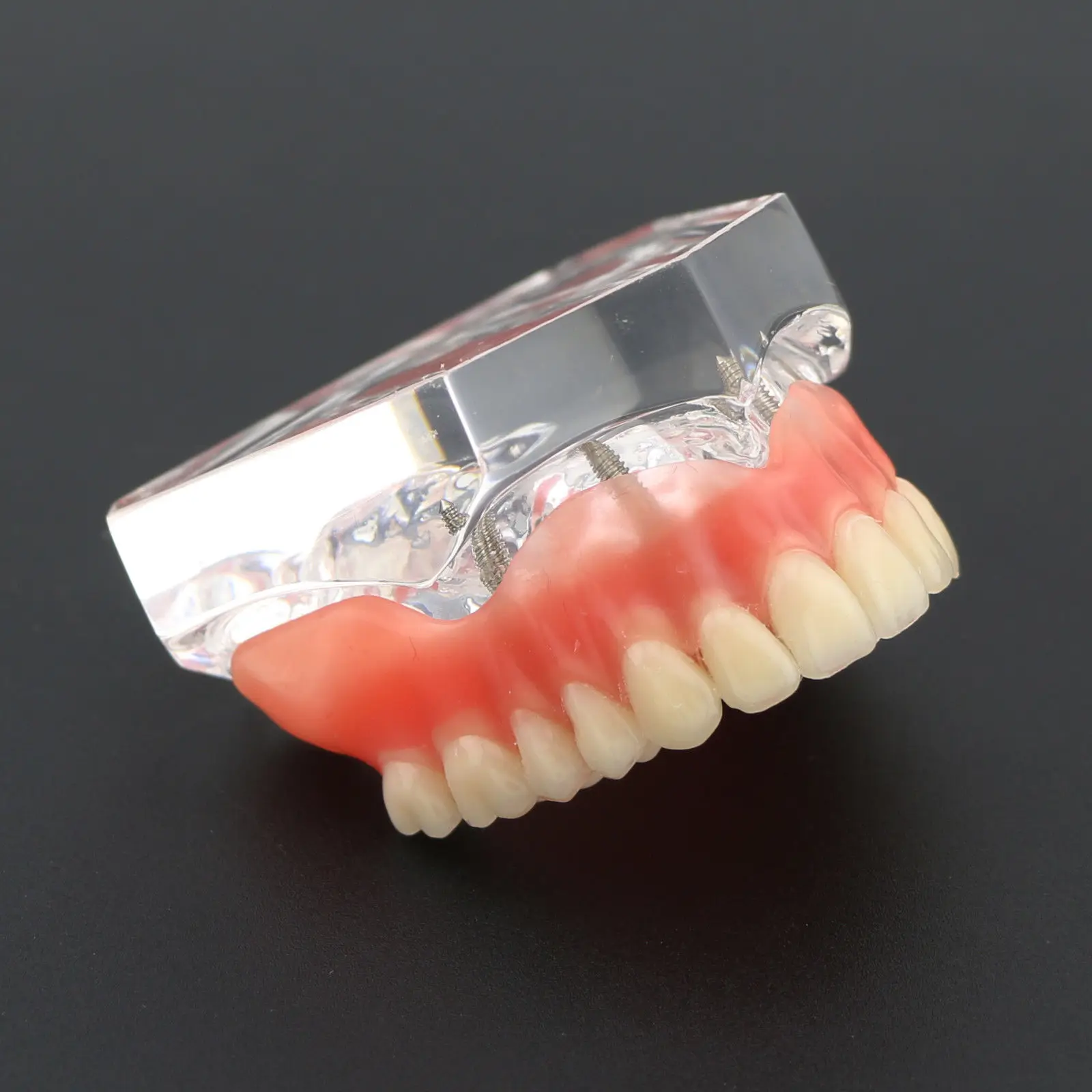 Dental Clear Acrylic Upper Teeth Model Overdenture Superior 4 Implants
