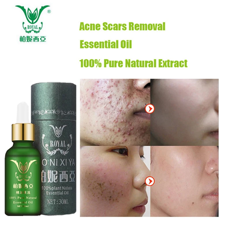 Face Care Essential Oil Acne Scar Spots Removal Skin Care Whitening Remove Scars Acne Repair Face 1