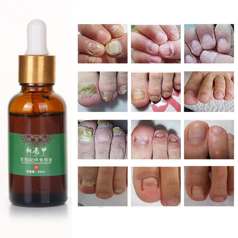 

Nail Fungus Removal Gel 30ml Onychomycosis Fungal treatment Nail Treatment Feet Care Essence oil Nail and Foot Whitening Toe