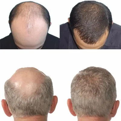 Queda de Cabelo Produtos de Cabelo Líquido o Crescimento do Cabelo Rápida para Mulheres dos Homens Ciytan Médica Essência Anti Denso Sunburst Crescer Tratamento Alopecia 2 Beleza e saúde