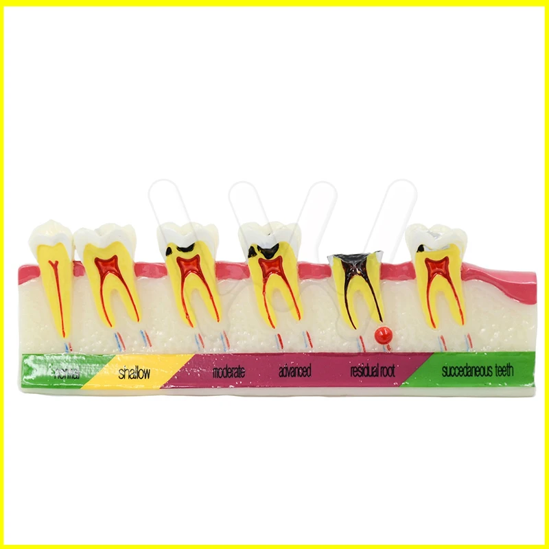 Dental-Caries-Developing-illusteation-Tooth-Model-Demonstration-Teach-_57 (1)