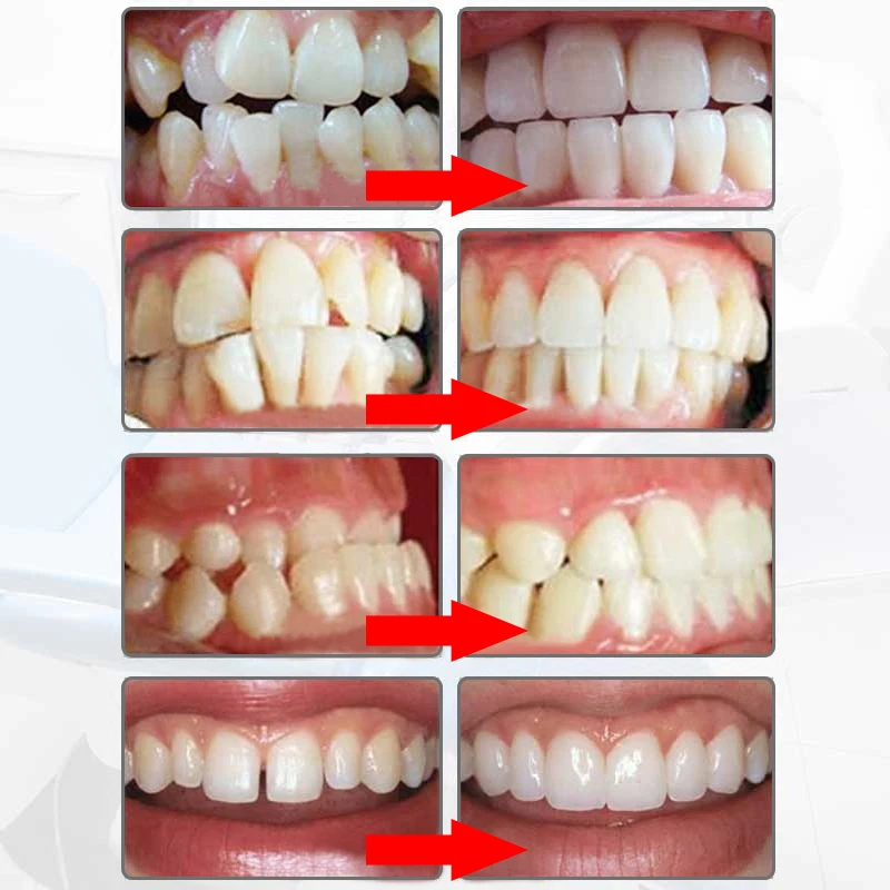 

Instant Perfect Smile Comfort Fit Flex Teeth Fits False Teeth Upper Comfortable Fake Tooth Cover Teeth Whitening Dental Braces