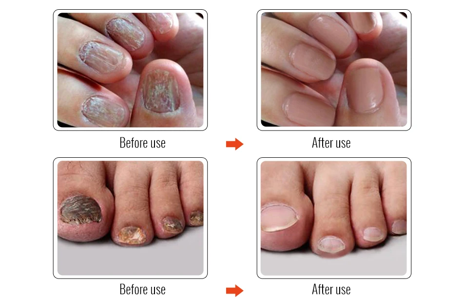 большая книга по заболеваниям ногтей анке нидерау. лечение ногтей волжский фуст. восстанавливающая сыворотка для удаления онихомикоза. индийское масло от грибка ногтей. онихолизис и онихомикоз.