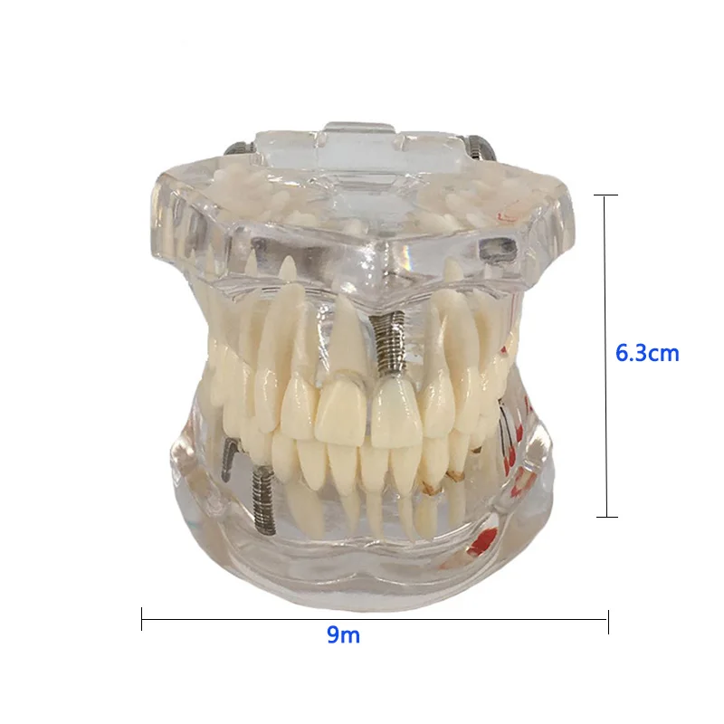 Стоматологический имплантат, модель зубов с реставрационным мостом, зубной Стоматолог для медицинских исследований