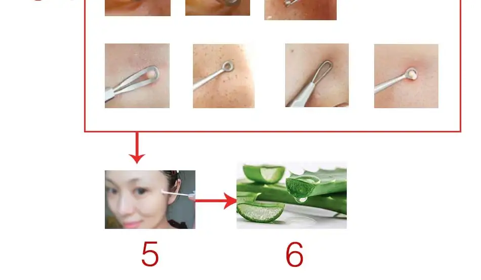 Blackhead-Remover-Tools-Pimple-Acne-Comedone-Zit-Extractor-Removal-Kit-Face-Cleaning-Kit-Treatment-for-Blemish-with-Mirror-Case_14