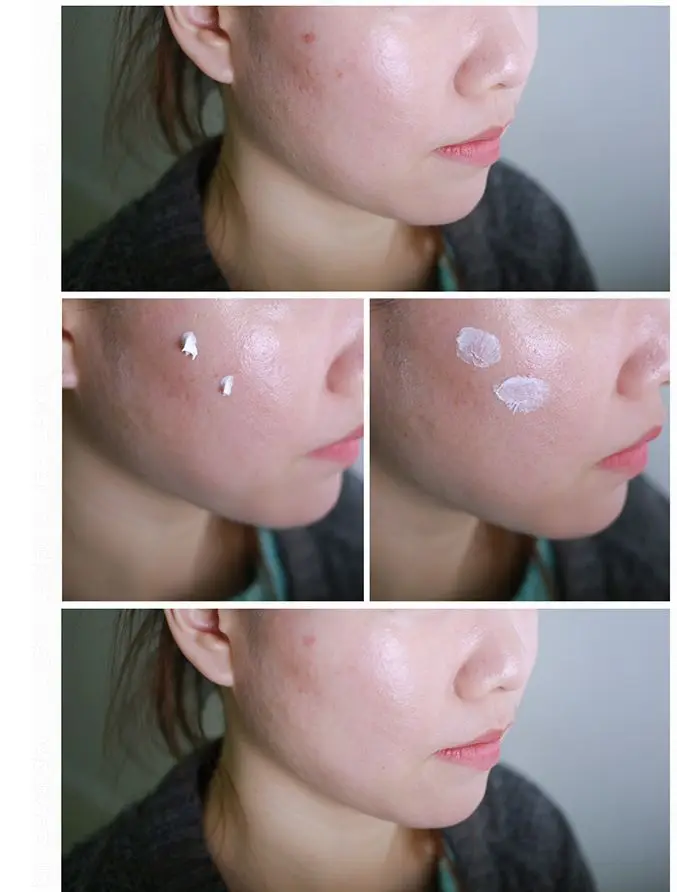 cosrx acne scar