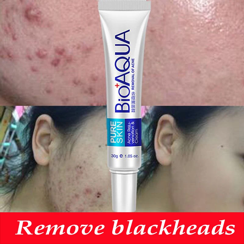 

Bioaqua 30g Acne Treatment Blackhead Remova Anti Acne Cream Oil Control Shrink Pores Acne Scar Remove Face Care Whitening