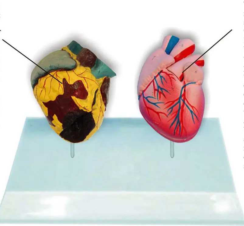 11 LifeSize Human Smoking Heart Vs Normal Heart Comparison Model Heart