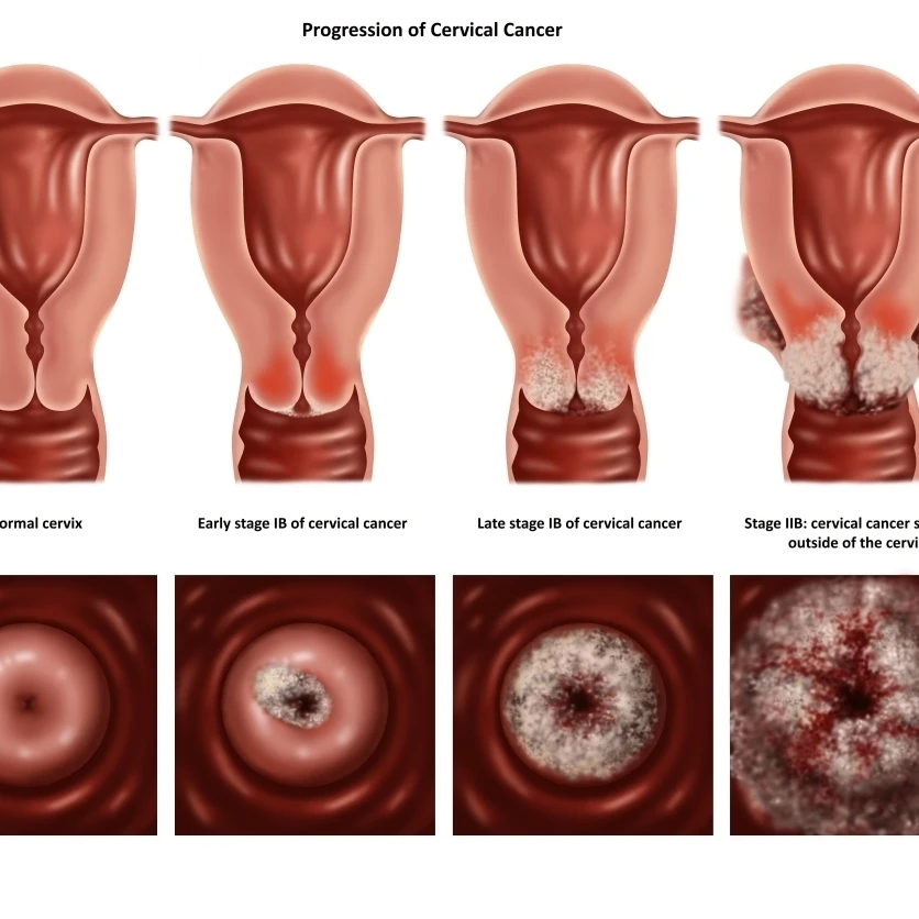 Cervical Cancer Poster Print by Gwen ShockeyScience Source (36 x 24)