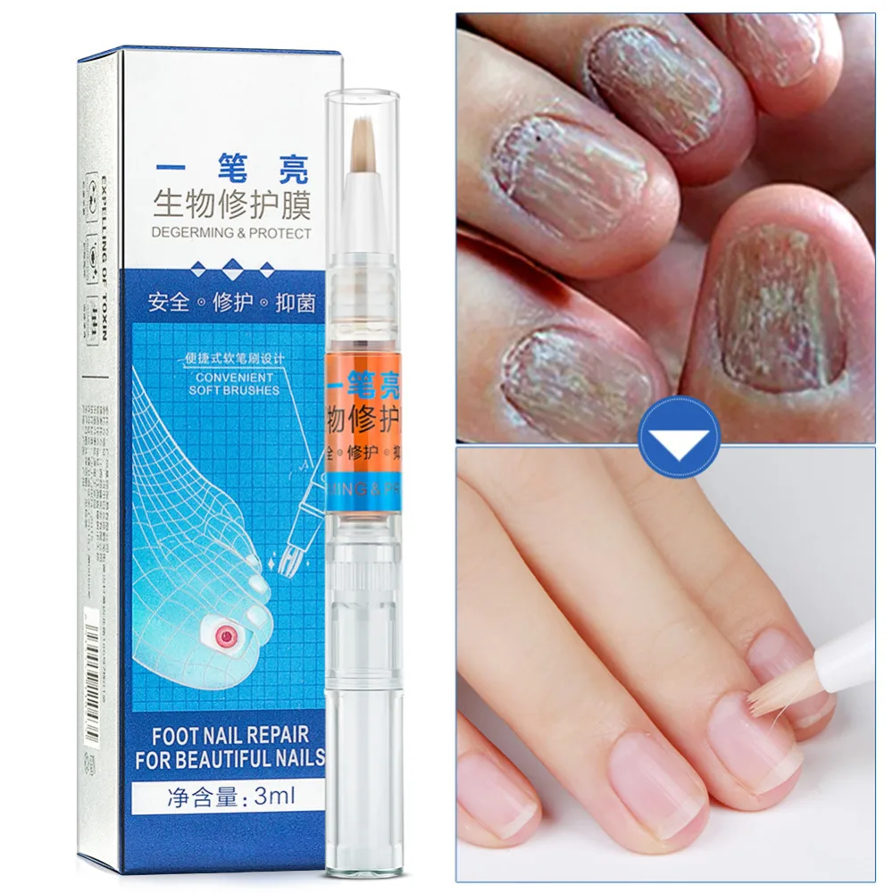 3ml Fungus Nail Treatment Liquid Anti Fungal Hand Foot Care Nail