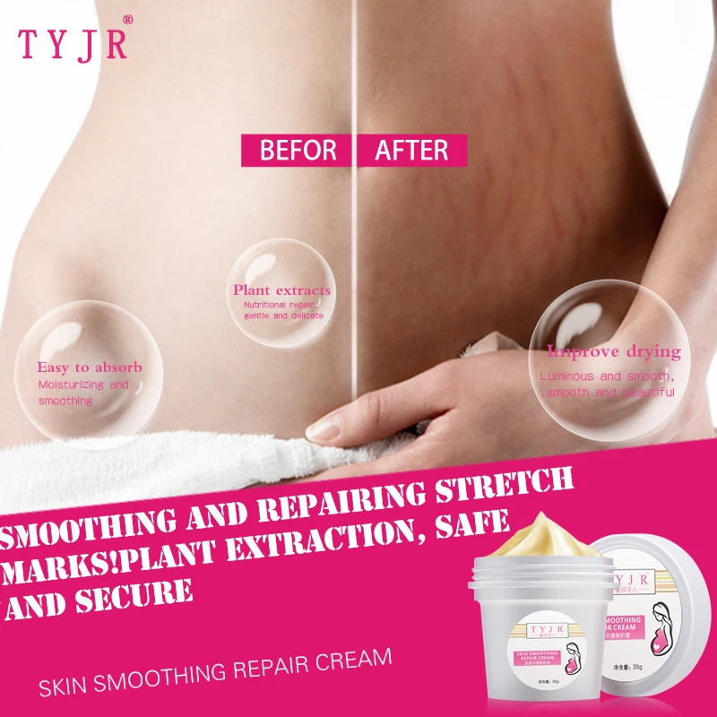 hips stretch marks removal cream