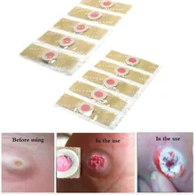 10 шт./лот мозоли для ног от мозолей, подошвенные бородавки, шип, обезболивающий пластырь, инструмент для ухода за ногами, медицинский стикер, защита для пальцев ног