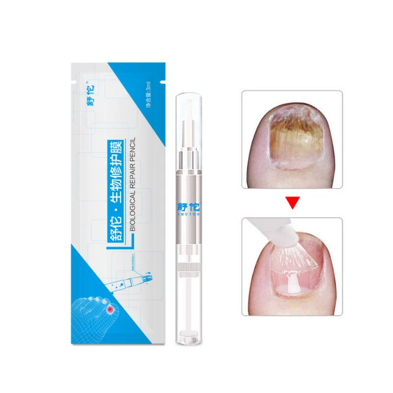 

Nail Fungus Treatment Essence Anti Fungal Nail Infection Chinese Herbal Care Onychomycosis Nails Repair Medicinal Liquid