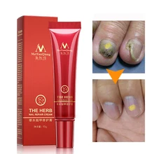 Травяное Лечение ногтей onychomicosis Paronychia против грибковой инфекции ногтей хороший результат Китайский Травяной Уход за ногтями