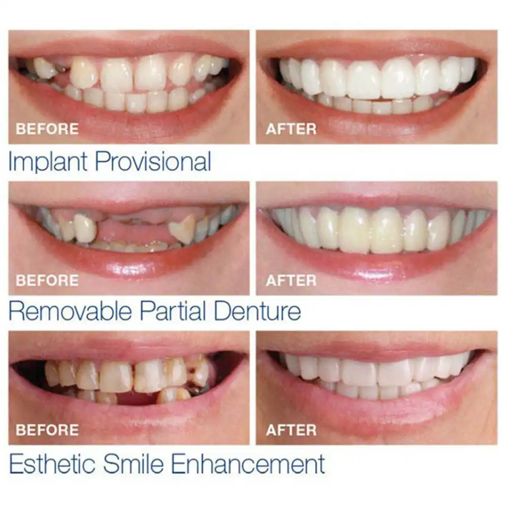 Denture Teeth Styles . The Different Types Of Dentures & False Teeth Explained By Dr Chhaya Chauhan (Gdc Electric Teeth.