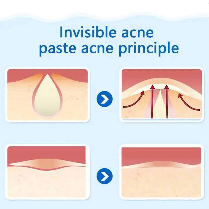 Harga 36 PCS Lembar Jerawat Patch Set Jerawat Bekas Luka Jerawat Pengobatan Stiker Jerawat Jerawat Master Patch Jerawat Pengobatan Jerawat Stiker
