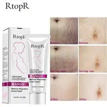 Манго удалить беременность шрамы крем от акне растяжки лечение Материнство ремонт анти-старения против морщин укрепляющие кремы для тела