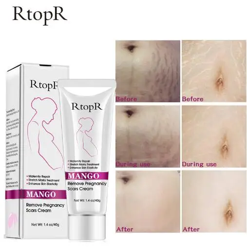 

Mango Remove Pregnancy Scars Acne Cream Stretch Marks Treatment Maternity Repair Anti-Aging Anti Winkles Firming Body Creams