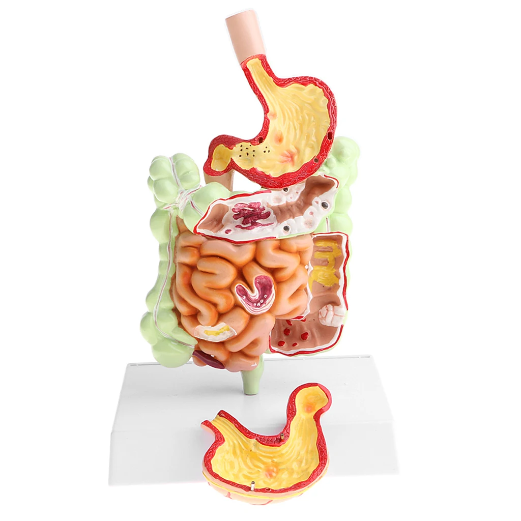 Minify 1X Human Large Intestine Stomach Pathological Model Medical Teaching Lab Demonstration Supplies