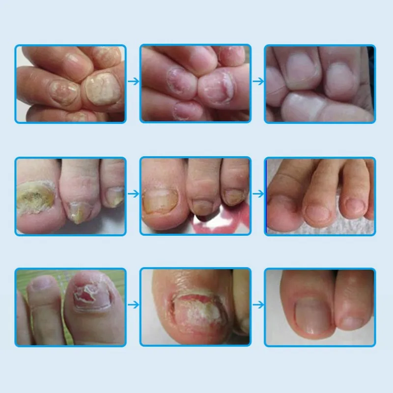 

New Removal Onychomycosis Paronychia Ance Oil Bactericidal Nail Fungal Nail Infection Toe Nail Fungus Treatment Care