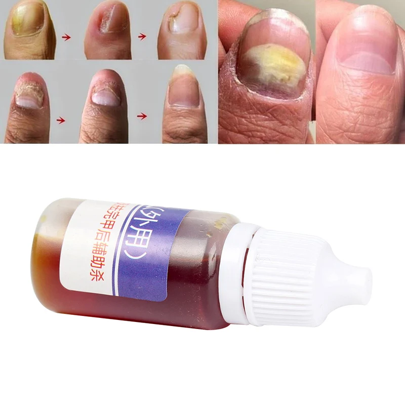 10 мл китайская травяная медицина грибковые лаки для ногтей Лечение эссенция для ногтей ремонт ног грибок для ногтей анти-инфекция Paronychia