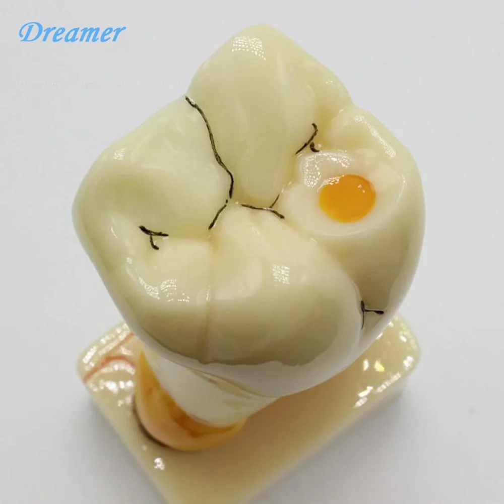 

Dental Teeth Common Pathologies Model Anatomy Model Anatomia Tooth Decay Model