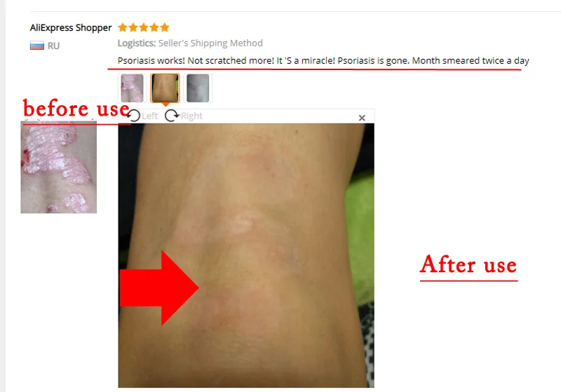 Cuidados com a Pele com Caixa Pces Pele Psoríase Dermatite Eczematoid Eczema Pomada Tratamento Creme Varejo 10 7 10 pces pele psoríase dermatite eczematoid eczema