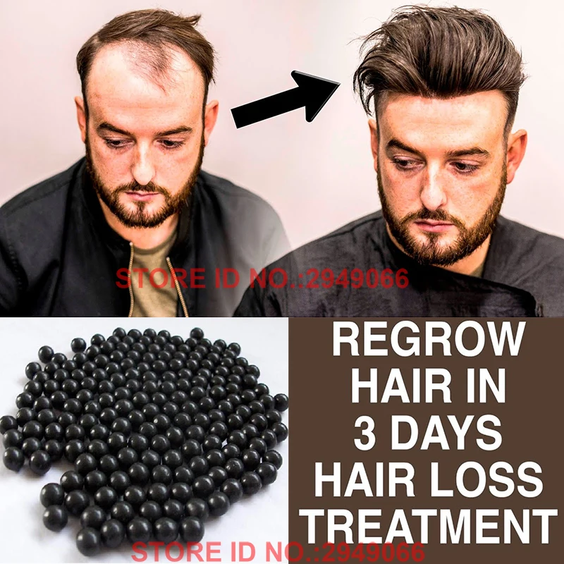 

100% Natural Chinese Remedy Formula for Men and Women Hair Loss Balding Intensive Hair Regrowth Restore Treatment Threapy