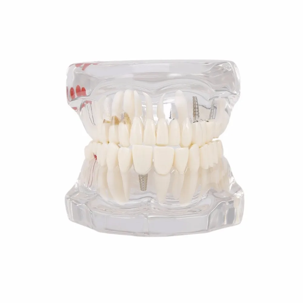 

Professional Detachable Fake Teeth Dental Disease Teeth Implantation Model Restoration Display Clinic Hospital Educational Use