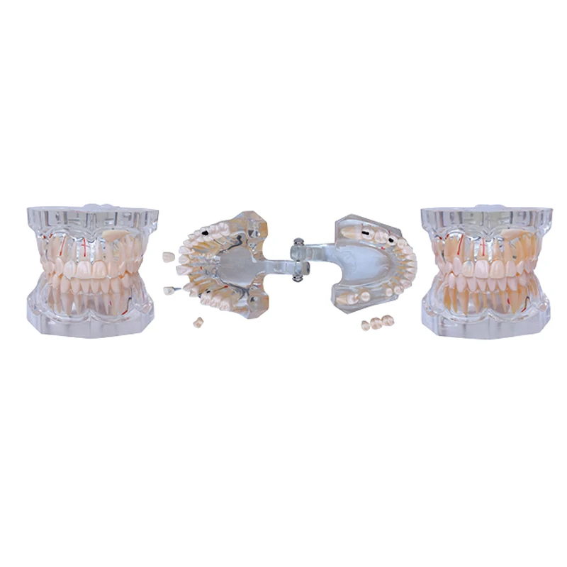 

1pc Dental study mode 2.5 Times Sized Giant Transparent Pathology Teaching Teeth Model with Removable Tooth