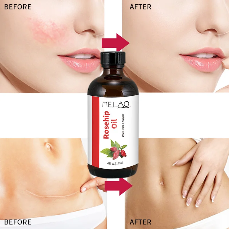 spesifikasi Melao 100% Murni Organik Rosehip Minyak Pelembab Menyembuhkan Kulit Kering   Garis Halus Rose Benih Minyak untuk Kulit Wajah minyak Pijat 118 Ml