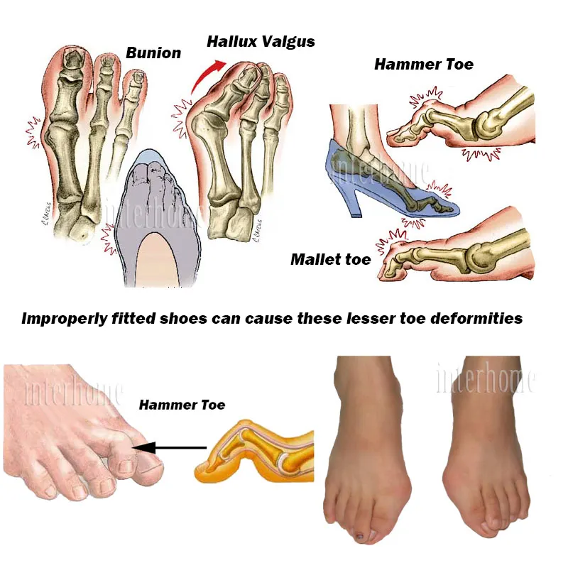 hammer-toe-foot2