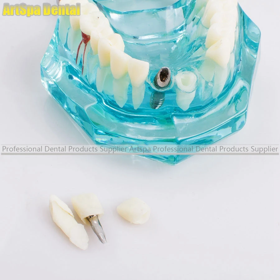  Dental Study Tooth Model Adult Pathological teaching Teeth model - 32832544472