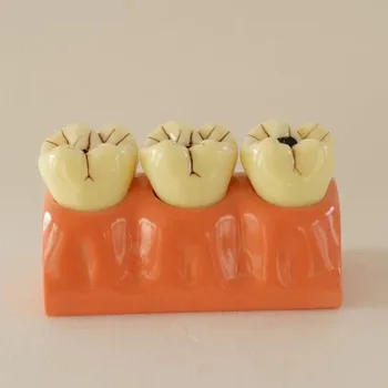 

4 Times Dental Caries Disassembling Model Decomposition of dental caries model