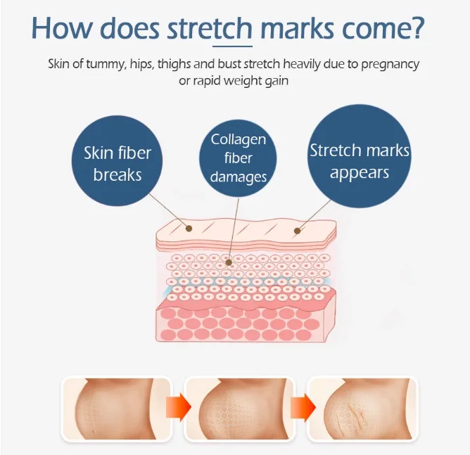 Эффективное удаление растяжек для удаления крема растение естественное заживление беременности груди бедра ноги растягивающийся крем