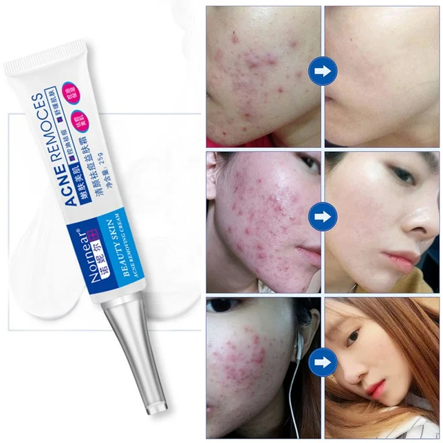 Face Cream Whitening Skin Care Anti Acne Treatment Cream Oil control