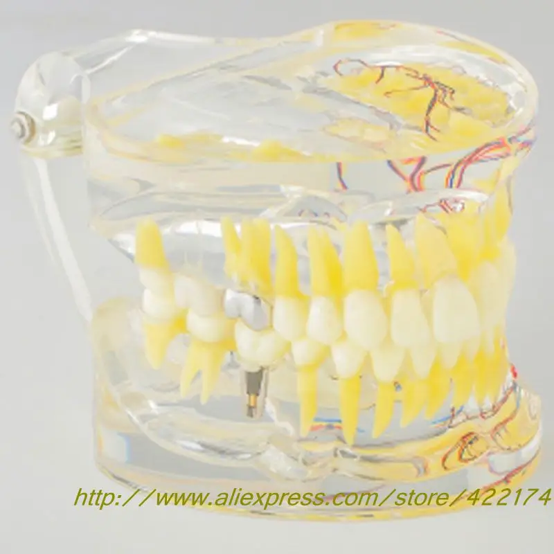 

Dental Adult pathological model With tooth nerve With inlay restoration