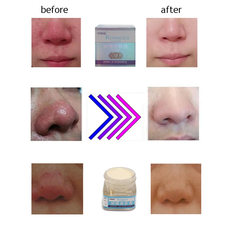 Apologise, Rosacea facial cream commit Have Rosacea facial cream pity, that