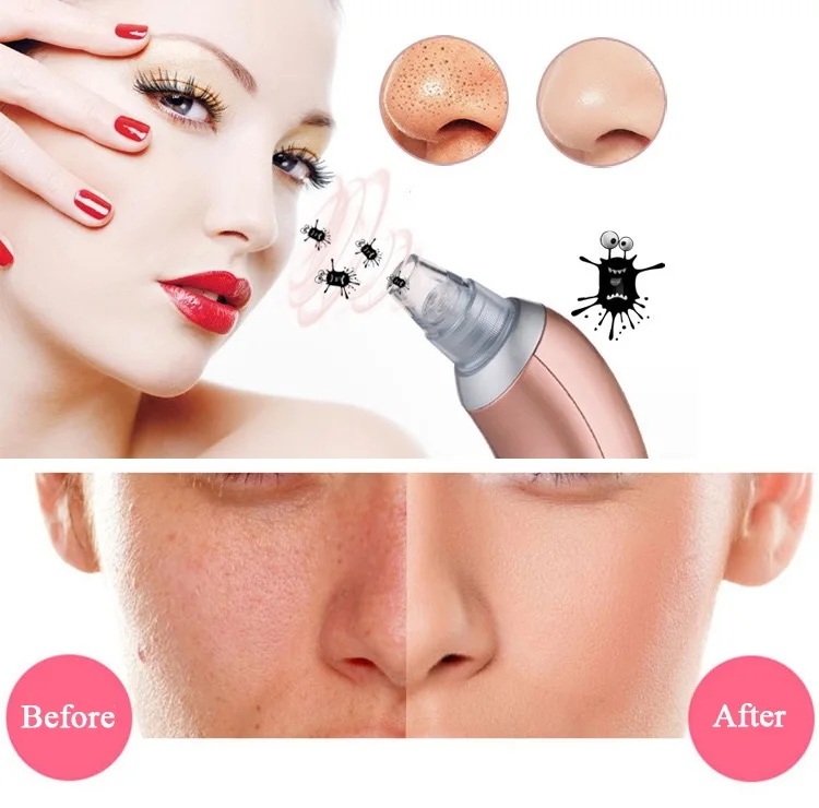 Blackhead-Vacuum-Extractor-Remover-Black-Head-Removal-Tool-Pore-Cleaner-Facial-Cleansing-Machine-Face-Skin-Care-Product-2018-New-arrivals (10)