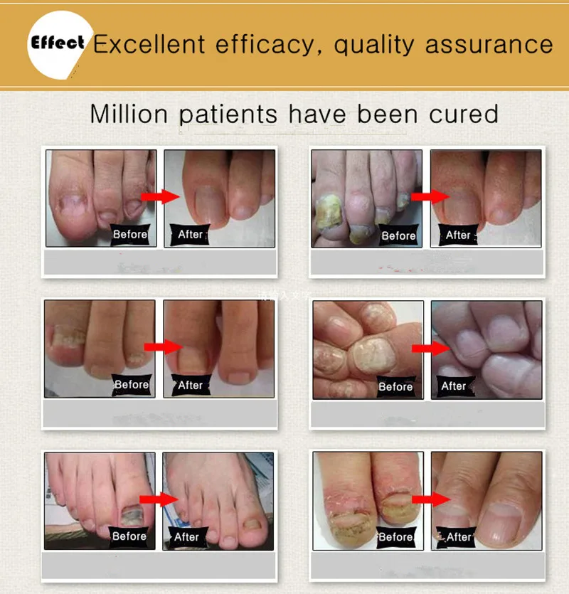 Купить 3 получить 1 подарок димолло грибковое Лечение ногтей эссенция для рук и ног гель для удаления грибка ногтей анти-инфекционный гель онихомикоз