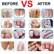 Хороший результат ручка для лечения Ногтей Onychomycosis Paronychia противогрибковые инфекция ногтей китайский травяной носок Лечение грибка