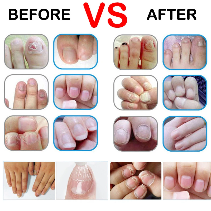 Good Result Nail Treatment Pen Onychomycosis Paronychia Anti Fungal Nail Infection Chinese Herbal Toe Nail Fungus Treatment Nail Treatments Aliexpress