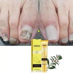 Ginженьшень средства для ухода за ногтями крем Удаляет онихомикоз гриб параонихиа способствует росту ногтей Крем для ног Уход за ногтями TSLM2
