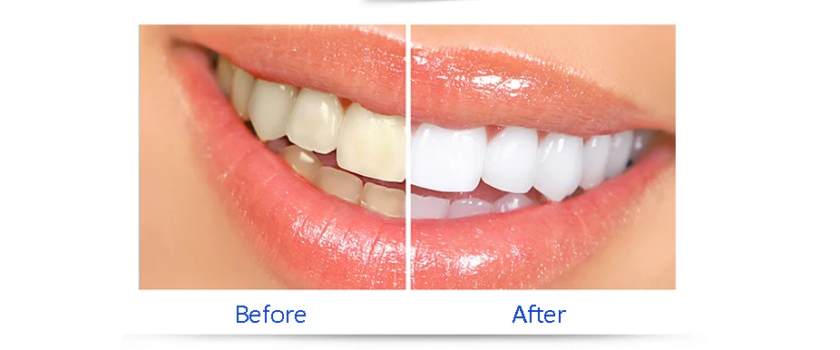 Mancha Removendo Higiene Oral Original, Efeitos Profissionais de Luxo