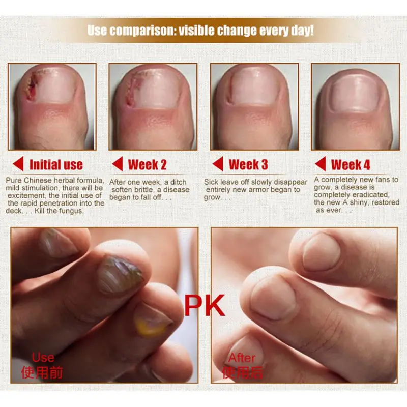 Herbal Fungal Nail Treatment Essential oil Hand and Foot Whitening Toe Nail Fungus Removal Infection Feet Nail Care