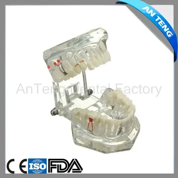 

Dental Implant Disease Teeth Model With Restoration Bridge Tooth Dentist For Medical Science Dental Disease Teaching Study