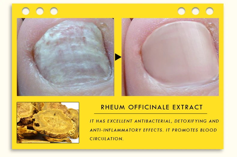 Травяное противогрибковое Лечение ногтей эфирных масел, экстракт китайской медицины, ремонт ногтей, Ноготь инфекция, уход за ногами